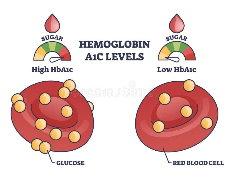 Diagram showing how glucose molecules attach to red blood cells, resulting in different Hemoglobin A1c levels indicating blood sugar control over time
