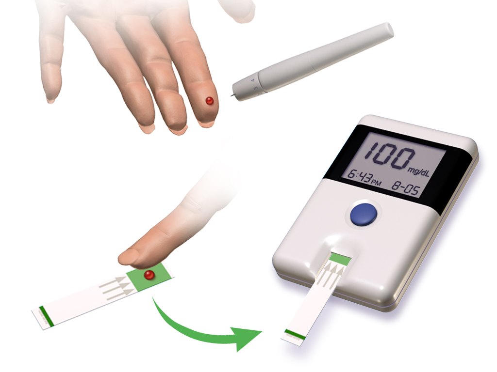 Fingerstick blood glucose testing with a digital glucose meter showing a blood sugar level of 100 mg/dL